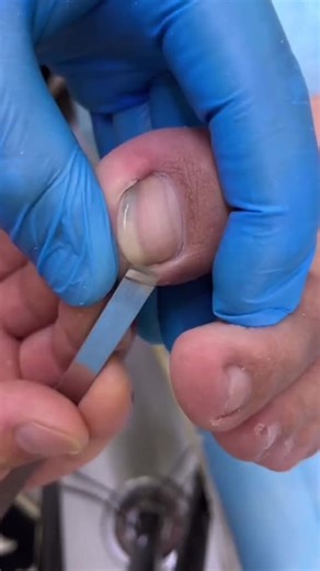 @doctornail49 | Dirty nail #fypシ #fyp #pedicure #ingrowntoenail | Instagram