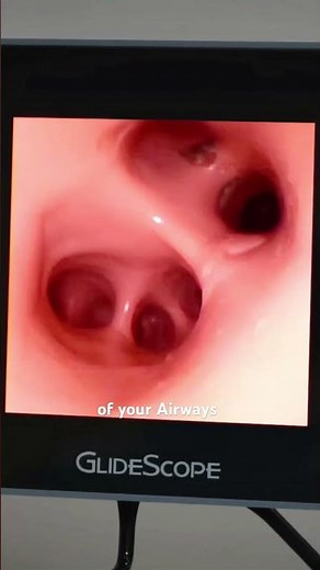 How Bronchoscopy is Performed? (3D Animation)#how #bronchoscopy #anesthesia #tube #surgery #surgeon