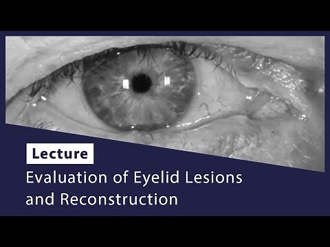 Evaluation of Eyelid Lesions and Reconstruction