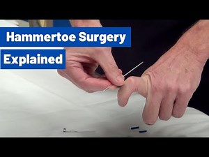 Hammertoe Surgery Explained by Dr. Moore (Using an 'Internal Pin')