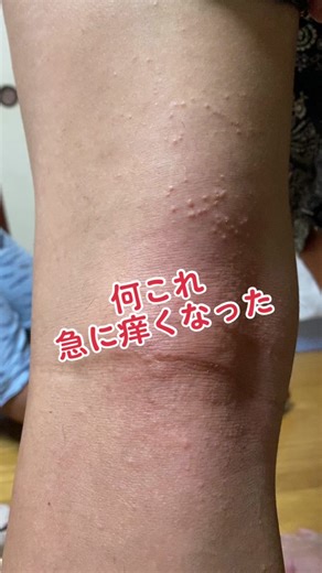 帯状疱疹の症状と対処法
