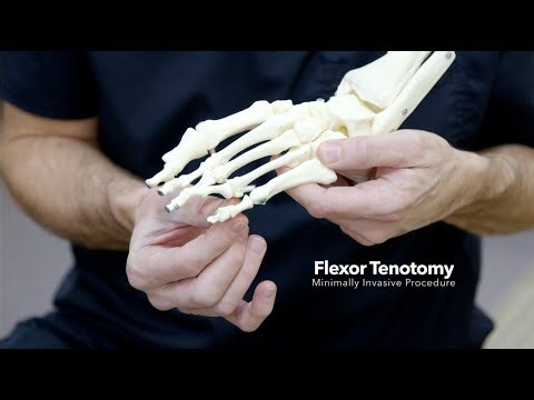 Dr. Joel Foster Provides Technique For Flexor Tenotomy Procedure
