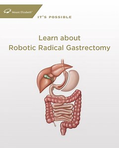 Robotic Radical/Subtotal Gastrectomy is a robot-assisted type of surgery to remove tumors. It is minimally invasive using fine tools to access the gastrointestinal (GI) tract and remove the benign tissues. This method has proved to be successful in treating gastric cancer as it causes less bleeding and has a shorter recovery time. Drop us a message or contact our Mount Elizabeth regional offices in Dhaka, Chattogram and Sylhet for more information on the available treatment options in Singapore.