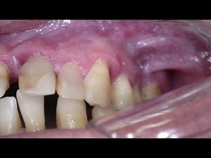 “Odontogenic Cysts Explained | Types, Symptoms & Treatment | MR TEETH”#mrteeth #jawdisease