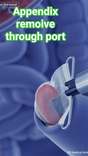 Removal through port #health #surgery #appendectomy #leproscopy #viralshorts #anatomy