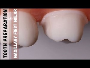 Maxillary First Molar | Tooth Preparation for PFM | Step by Step Demonstration • Video • MEDtube.net