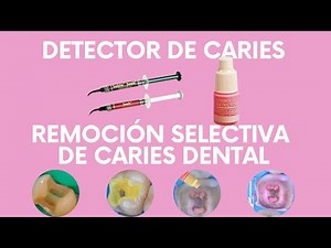 Caries Detector and Selective Caries Removal