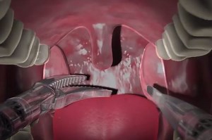 UCLA researcher develops robotic surgery technique to treat previously inoperable head and neck cancer