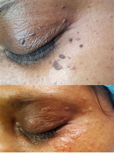 Removing Skin Tags with Cauterization Near the Eye