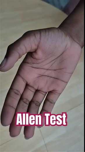 Uni Medical care | The Allen test is a clinical examination used to assess the integrity of blood flow to the hand via the radial and ulnar arteries. This... | Instagram