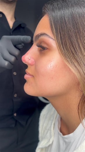 Explore Liquid Rhinoplasty Benefits and Procedure