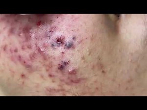 acne treatment nhat bang spa #19