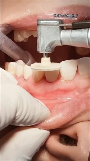 Tooth colour filling and shaping done 🎯 #cutfrom#greenscreen #reaction #shorts