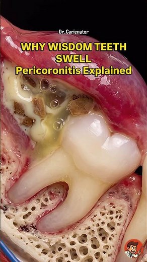 Pericoronitis: The hidden cause of wisdom tooth pain 🦷 #dentist