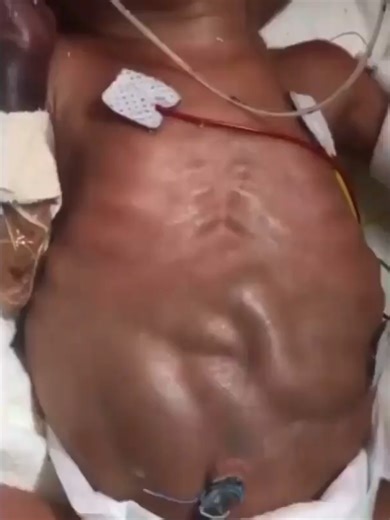 Understanding Distal Bowel Obstruction in Preterm Infants