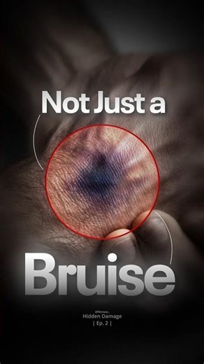 ⚠️That “Blue Bruise” Might Not Be Normal | Hidden Damage Ep.2