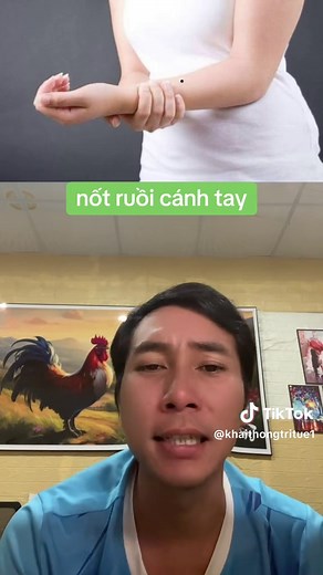 Nốt Ruồi Cánh Tay: Ý Nghĩa và Đặc Điểm