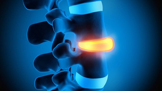 Was ist die Bandscheibe genau? Eine Definition