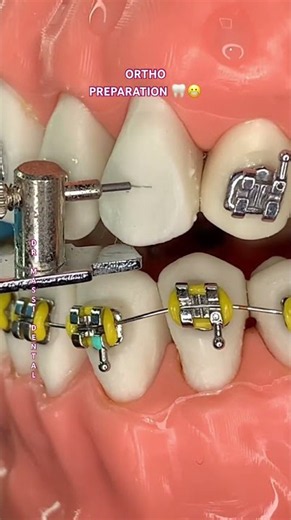 ORTHODONTICS PREPARATION 😬🦷