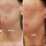 ZitSticka Killa Microdart Pimple Patches for Face - Most Potent Pimple Patch with Fast-Acting Microdarts - For Deep, Early-Stage Zits with Salicylic Acid - Mini 16 Count