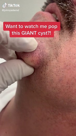 #cystpopping #cysticacne #lipomaremoval #pimplepopping #cystremoval #medschool #fyp #dermatologist