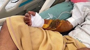 Snake catcher in critical condition after being bitten by cobra