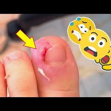 Step by step how to cut ingrown nail by professional