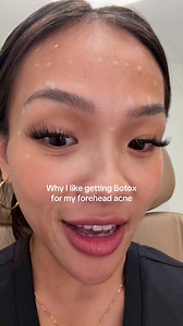 Botox for Forehead Acne: Does it Help?