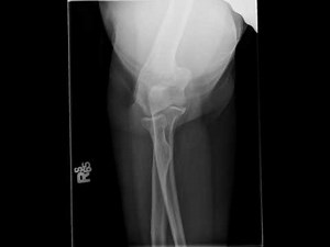 Radial Head Fracture