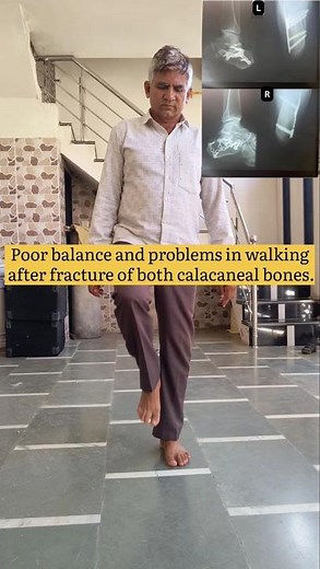 "Calcaneus Fracture Recovery: Fast Healing Tips & Exercises!" #fracture #recovery #shorts