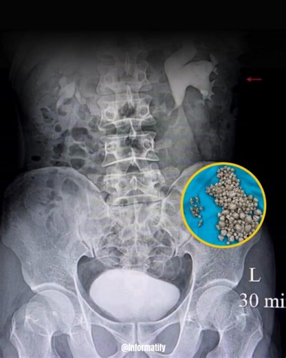 This is a CT scan of a 20-year-old woman who suffered from severe back pain and fever. After days of unbearable symptoms, she went to the hospital for a check-up — and doctors found that her kidney was packed with over 300 stones, all linked to one daily habit… full details and images 👇 | Women Life