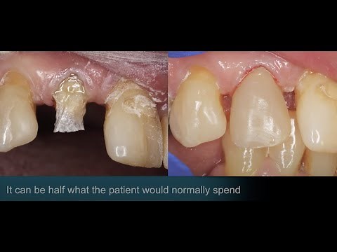 Build Up and Benefits of fiber reinforced composites by Dr. Jeffrey Hoos, DMD