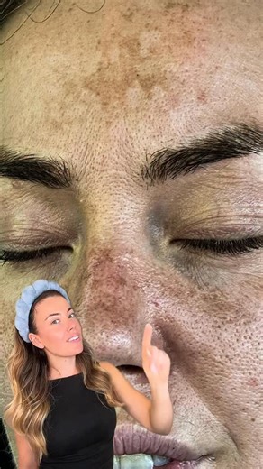 83 reactions · 22 shares | ✨ 4 Steps to Treat Dark Spots (My Simple...