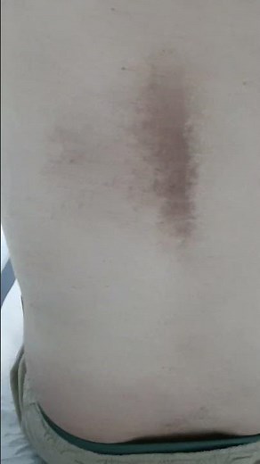 Notalgia paraesthetica