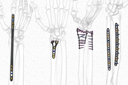 FREEFIX® Forearm Plating System - Skeletal Dynamics