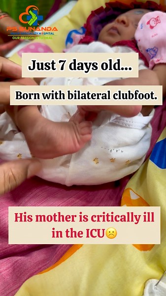 Born with b/l club foot #ctev #orthopedics #orthoconcepts