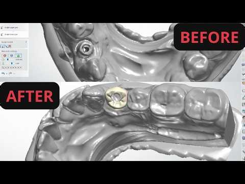 Dental implant restoration tooth 28 3shape digital