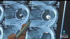 20K views · 190 reactions | Bankart lesions can quietly destabilize...