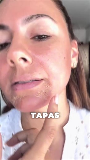 Descubre cómo el melasma afecta tu autoestima