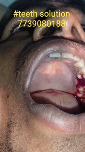 Teeth extraction 7 no teeth extraction #dentalartistry