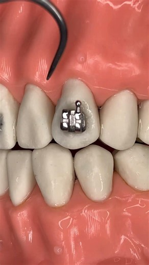 🔥Installation of Metal Orthodontic Brackets🔥