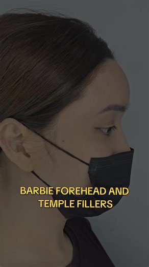BARBIE FOREHEAD AND TEMPLE FILLERS 🩷One of the most important areas for facial feminization. 🩷A non-surgical solution using Hyaluronic acid fillers to address volume loss, irregular shape and contour of the forehead. 🩷Much like any injectable treatments, there are mild side effects associated, including swelling, bruising, and redness at or near the injection site but typically resolves quickly. 🩷The greatest benefit of forehead fillers is the appearance of a rounder and more feminine shape.