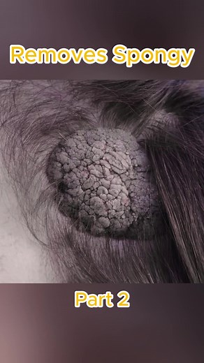 Seborrheic Keratosis Treatment with Dr. Lee
