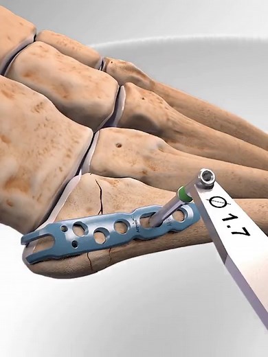 Metatarsal Fracture Repair: Surgery and Recovery Tips