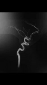 Anterior circulation #neurovascular | Neurology