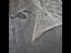 LM to LAD with heavy calcification | Complex PTCA + Stenting | Dr. Rajat Rawat | Agra Heart Centre