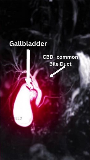 mrcp 🩺🧑‍⚕️ #shorts #mrcp #radiology #liver #gallbladdercancer