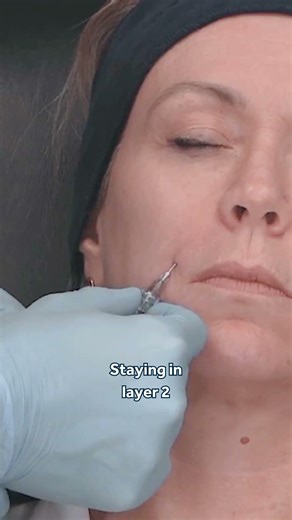 Evidence-Based Nasolabial Fold Filler Injection Techniques 💎 Global Evidence Matrix (GEM©️)