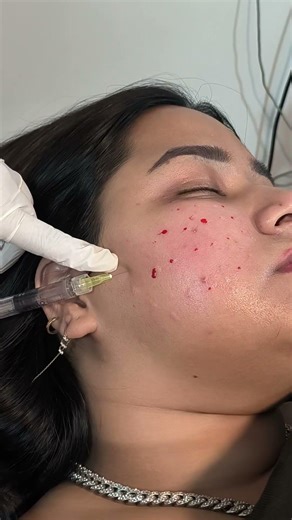 Booster treatment for skin and hair #aestheticmedicine #brightskin #antiaging #haircare