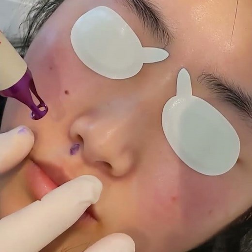 Laser Mole Removal - London Skin Clinic